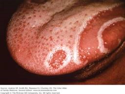 Geographic tongue with pain and burning sensation