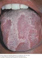 Geographic tongue